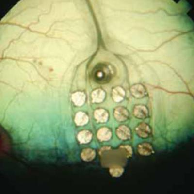 Artificial Retina Array 2